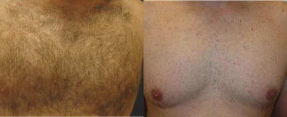 Chest laser hair removal before and after