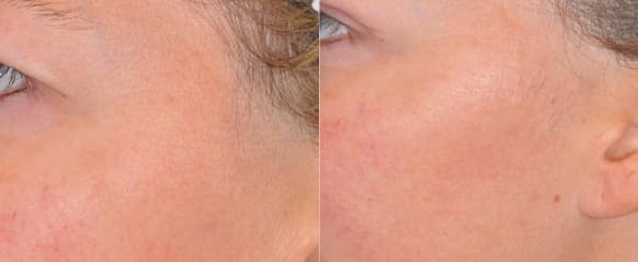 Facial laser hair removal before and after