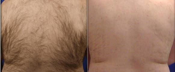Back laser hair removal before and after