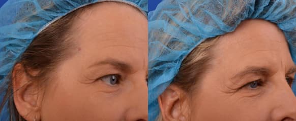 Radio Frequency Skin Treatment before and after