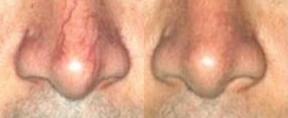 Radio Frequency Skin Treatment before and after