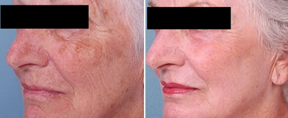Before and after skin resurfacing