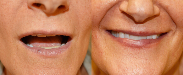 Before and after skin resurfacing