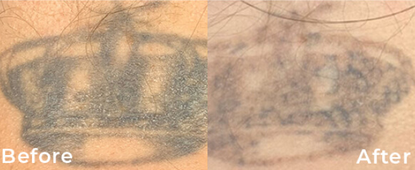 Before and after tattoo image.