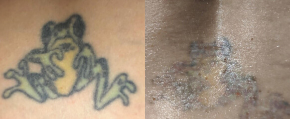 Before and after tattoo image