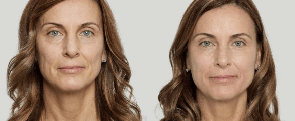 Before and after Sculptra