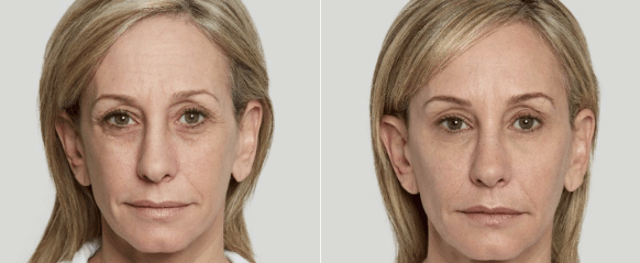Before and after Sculptra