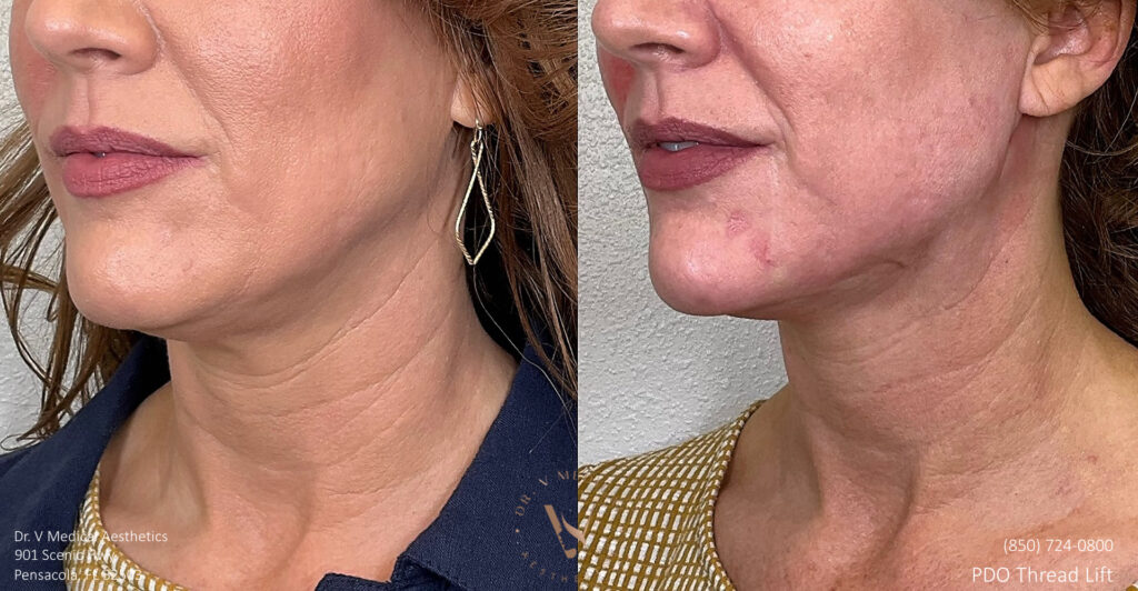 middle aged woman received PDO thread lift procedure