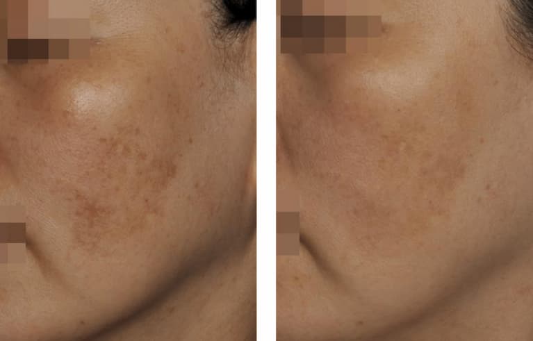 Before and after melasma treatment