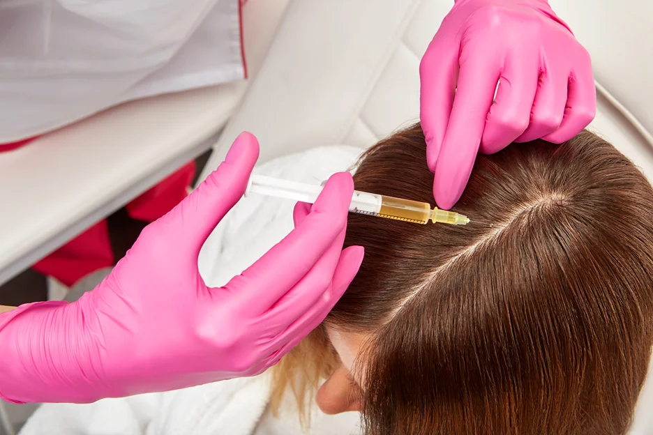 a woman received prp injection on her scalp