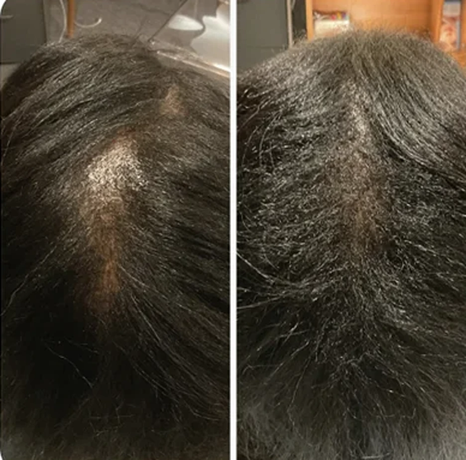 PRP For Hair Restoration Specialist - Naples, FL: SWFL Dermatology Plastic  Surgery & Laser Center: Dermatologist