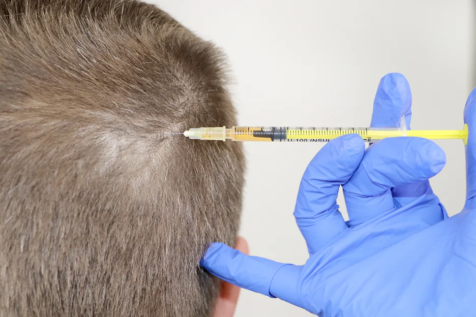 a  man received prp injection for his hair loss treatment